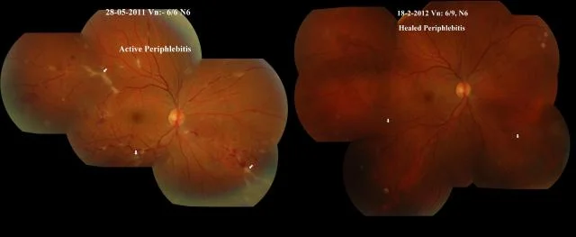 Eale's Disease Treated With Anti-koch's