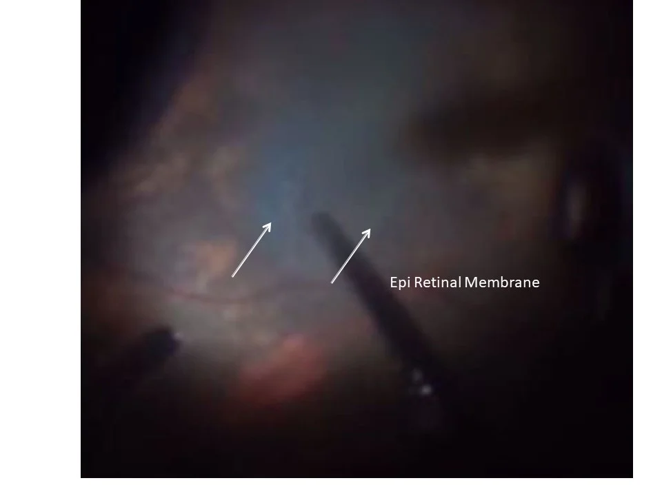 Diabetic Retinopathy Treated With Laser Treatment