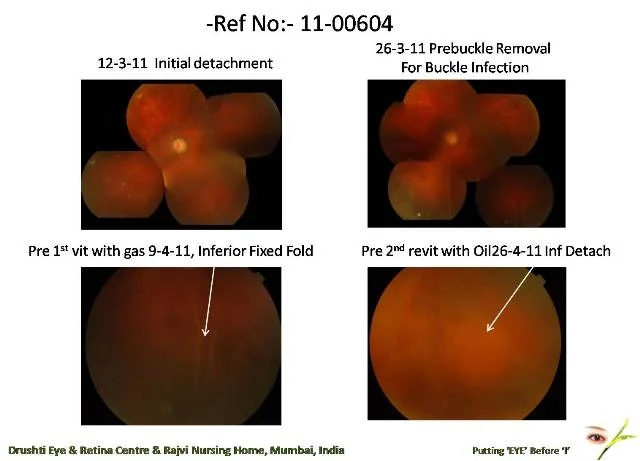 Good Outcome After Multiple Surgeries For Retinal Detachment Ref No - 11-00604
