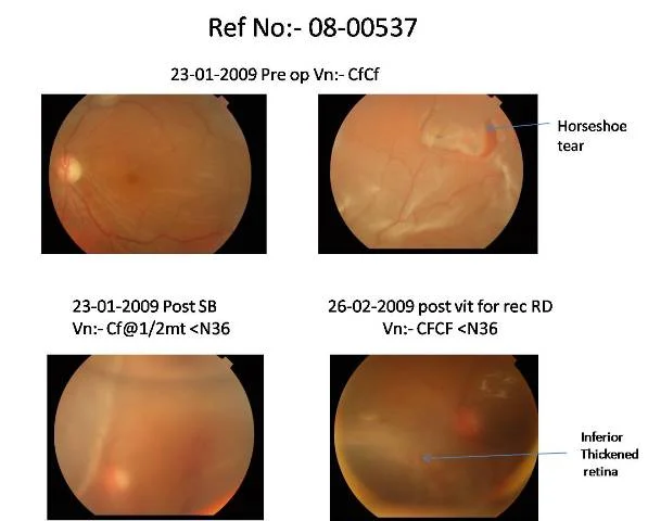Vitrectomy For Recurrent Retinal Detachment With Pvr D2 Ref. No 08-00537