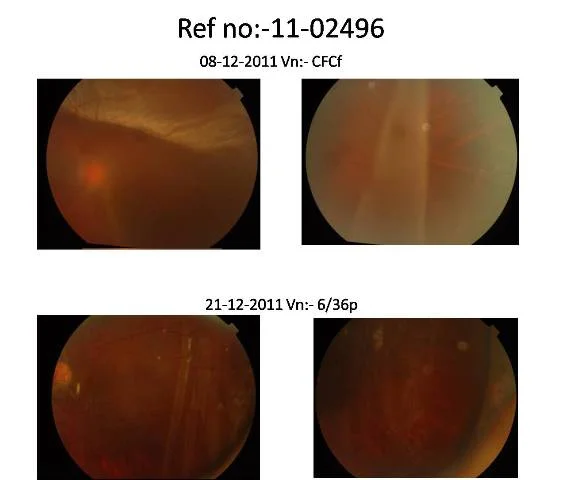 Revitrectomy For Recurrent Retinal Detachment With Pvr, Following Slipped Edge Of Giant Retinal Tear Ref No:- 11-02496