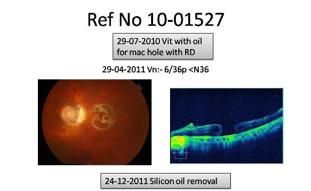 A Patient Of Macular Hole With Retinal Detachment Who Improved After Multiple Vitrectomies Ref No:-10-01527
