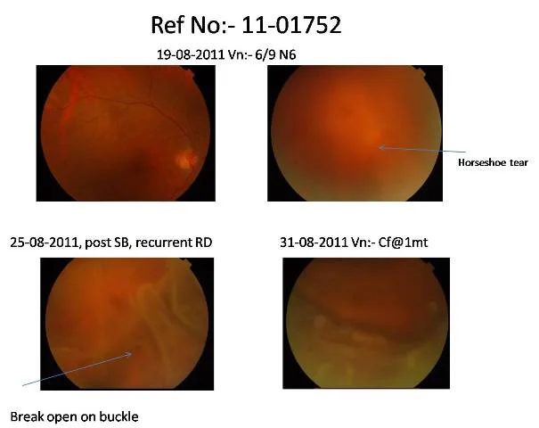 Vitrectomy for recurrent retinal detachment post scleral buckling Ref no.11-01752