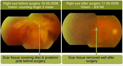 Diabetic Retinopathy Treated With Surgery
