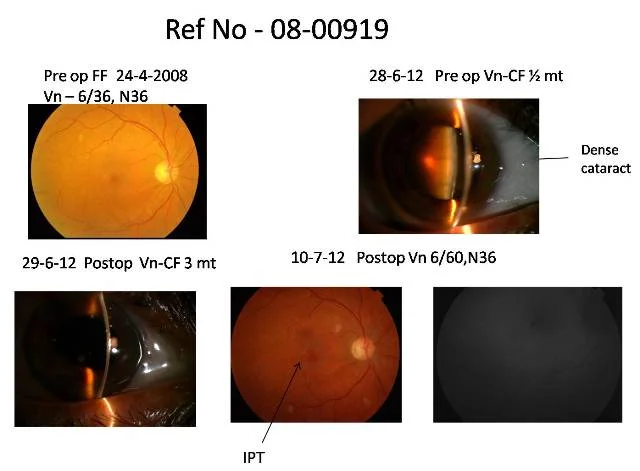 Cataract With Parafoveal Telangiectasia ( Ref No 08-00919)
