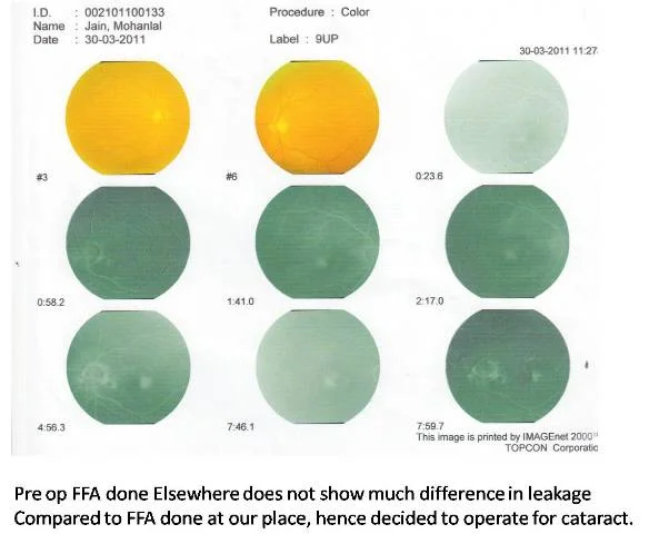 Cataract with Parafoveal Telangiectasia ( Ref No 02-01069)