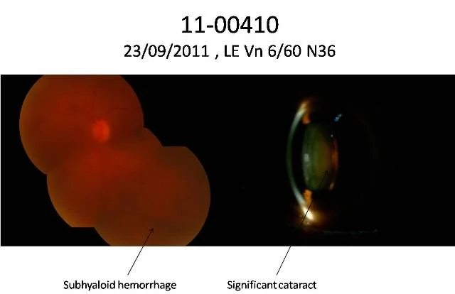 Cataract With Subhyaloid Hemorrhage ( Ref No 11-00410)