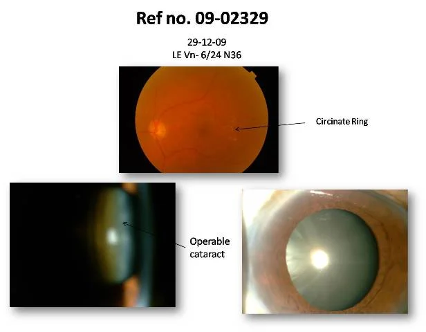 Importance of OCT in preop evaluation (Ref No 09-02329)