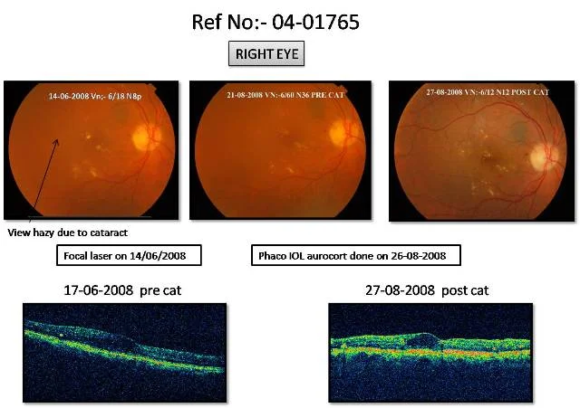 Cataract with Diabetic Maculopathy (Ref No:- 04-01765)