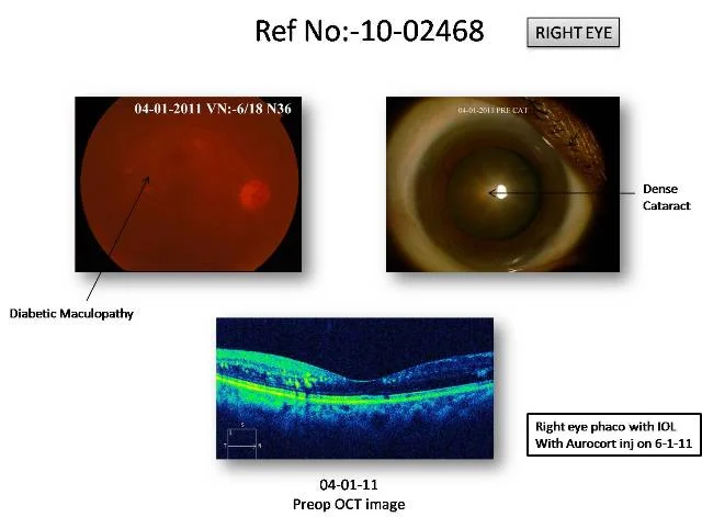 Cataract with Diabetic Maculopathy (Ref No:10-02468)