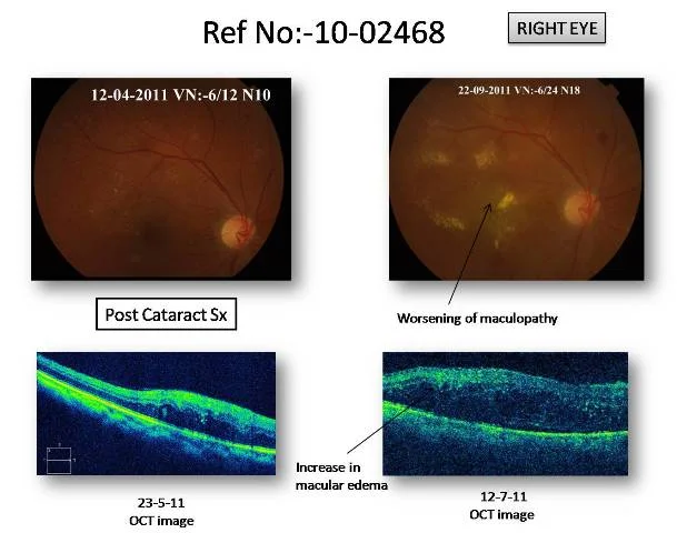 Cataract with Diabetic Maculopathy (Ref No:10-02468)