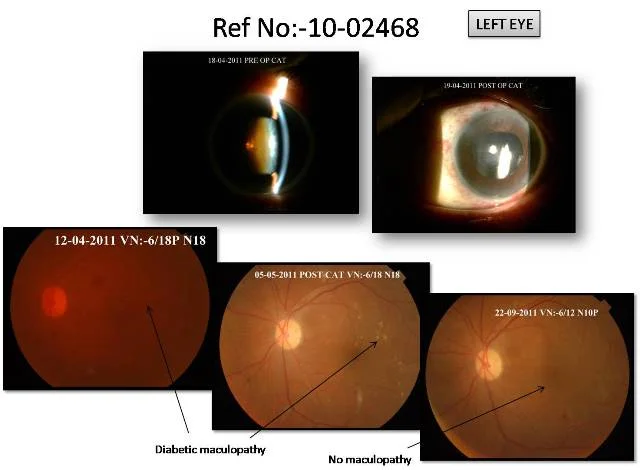 Cataract with Diabetic Maculopathy (Ref No:10-02468)