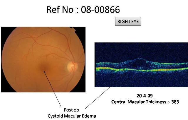 Cystoid Macular Edema post Cataract Surgery (Ref No : 08-00866)