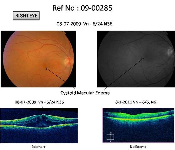Cataract Surgery Followed by Cystoid Macular Edema, treated with oral Diamox (Ref no :09-00285)