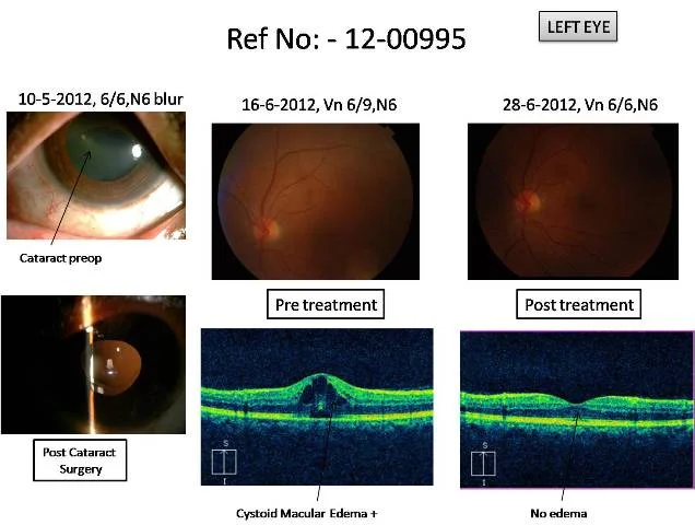 Cataract Surgery followed by Cystoid Macular Edema, treated with eye drops only (Ref No:12-00995)