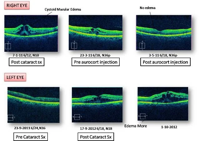 Cataract Surgery followed by Cystoid Macular Edema, treated with Aurocort Injection (Ref No : 04-02037)
