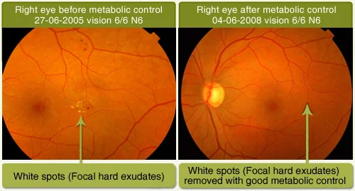 Diabetic Retinopathy Treated Without Treatment