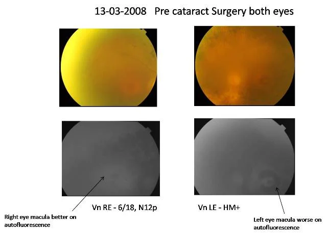 Cataract With Retinitis Pigmentosa (Ref No:08-00592)
