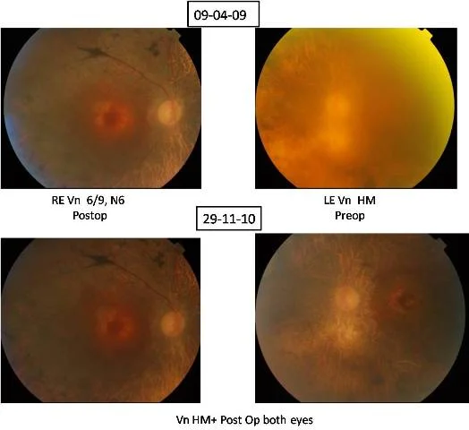 Cataract With Retinitis Pigmentosa (Ref No:08-00592)