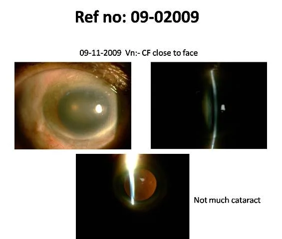 Patient was advised cataract surgery elsewhere, Ethambutol toxicity was missed (Ref No 09-02009)