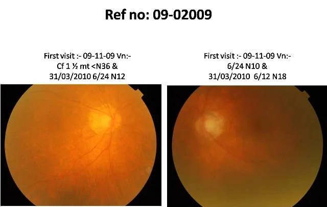 Patient was advised cataract surgery elsewhere, Ethambutol toxicity was missed (Ref No 09-02009)