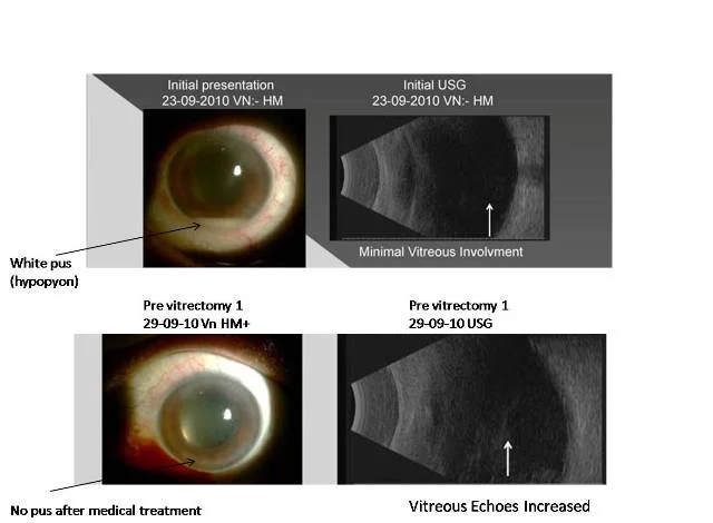 Postoperative Endophthalmitis (Infection) Managed With Vitrectomy With Excellent Result (Ref No:10-01965)