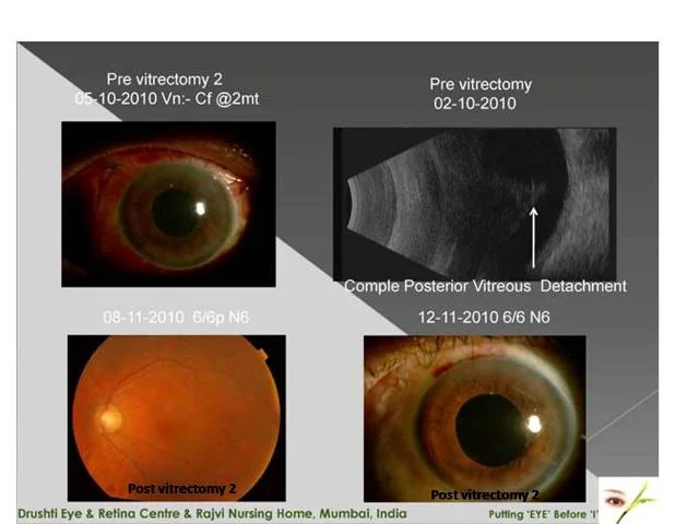 Postoperative Endophthalmitis (Infection) Managed With Vitrectomy With Excellent Result (Ref No:10-01965)