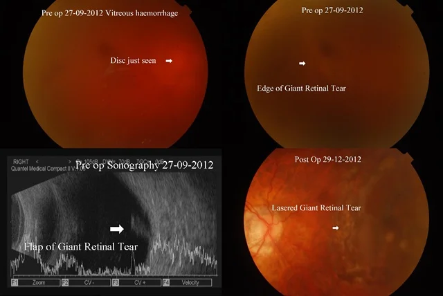 Ref No:- 12-01838 Vitrectomy for Giant Retinal Tear with Retinal Detachment