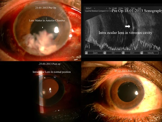 Ref No:- 13-00109 Complication of Cataract Surgery