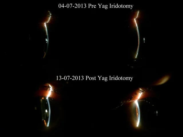 Secondary Glaucoma Following Retinal Surgery