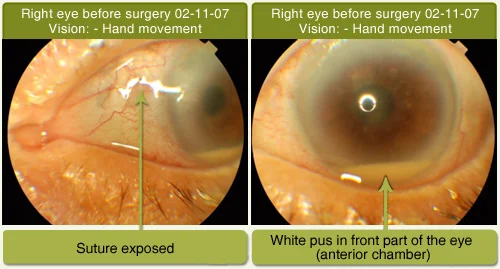 Endophthalmitis (Infection) Treated With Surgery