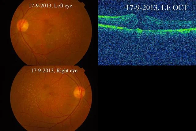 Role Of Optical Coherence Tomography