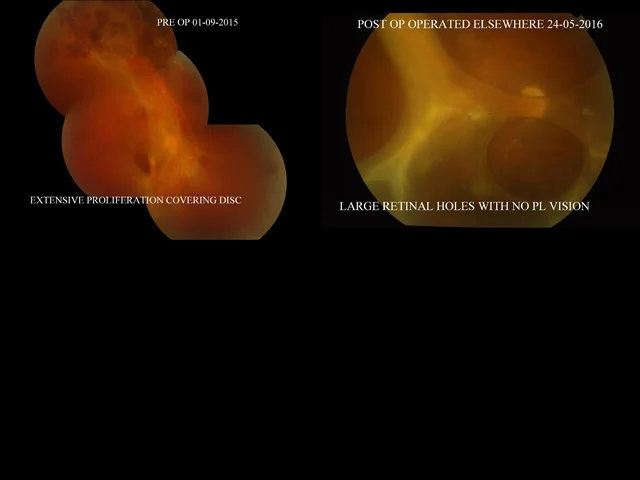 Whether Gauge Is Important In Vitreous Surgery ?