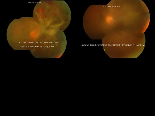 Whether Gauge Is Important In Vitreous Surgery ?