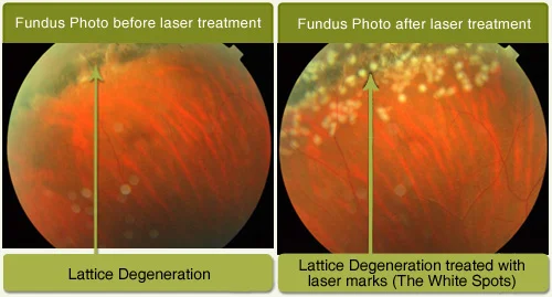 Lattice Degeneration