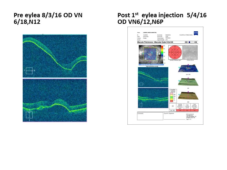 Spontaneous Closure Of Macular Hole Despite Presence Of Posterior Vitreous Detachment Pre Macular Hole Formation