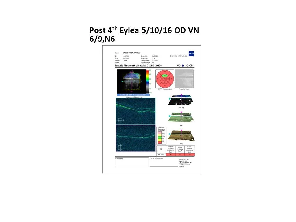 Spontaneous Closure Of Macular Hole Despite Presence Of Posterior Vitreous Detachment Pre Macular Hole Formation