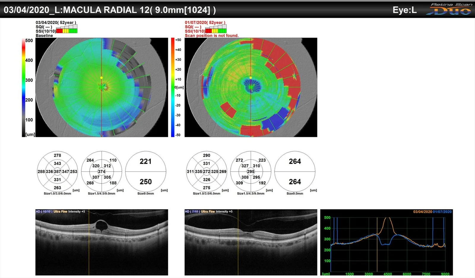 Spontaneous Closure Of Macular Hole Despite Presence Of Posterior Vitreous Detachment Pre Macular Hole Formation