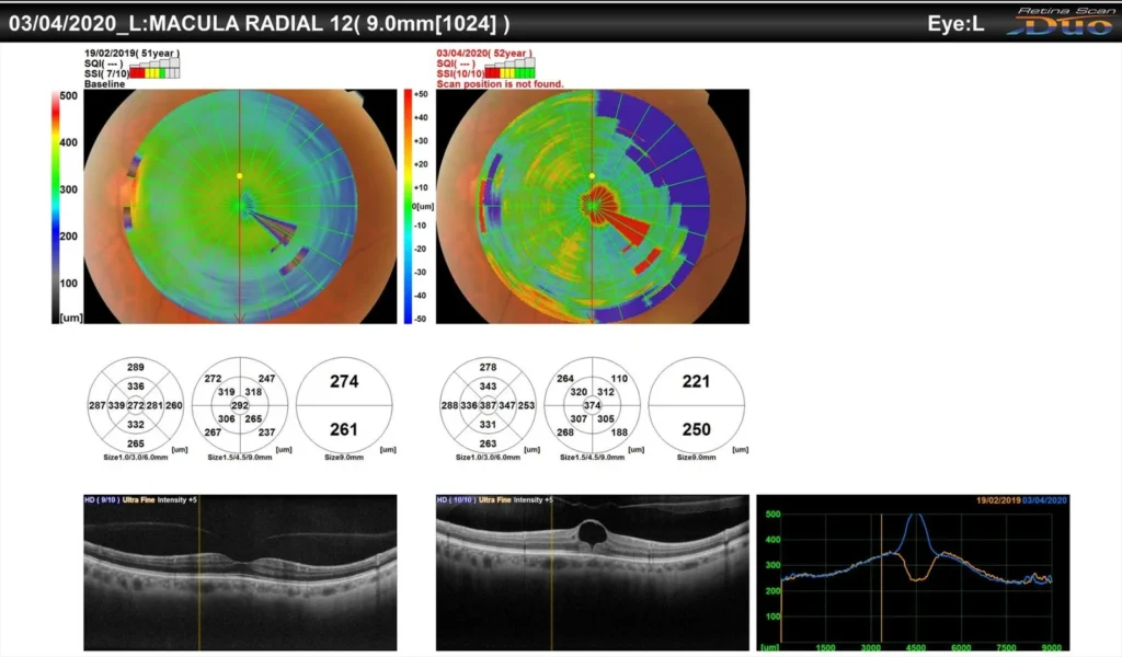 Spontaneous Closure Of Macular Hole Despite Presence Of Posterior Vitreous Detachment Pre Macular Hole Formation