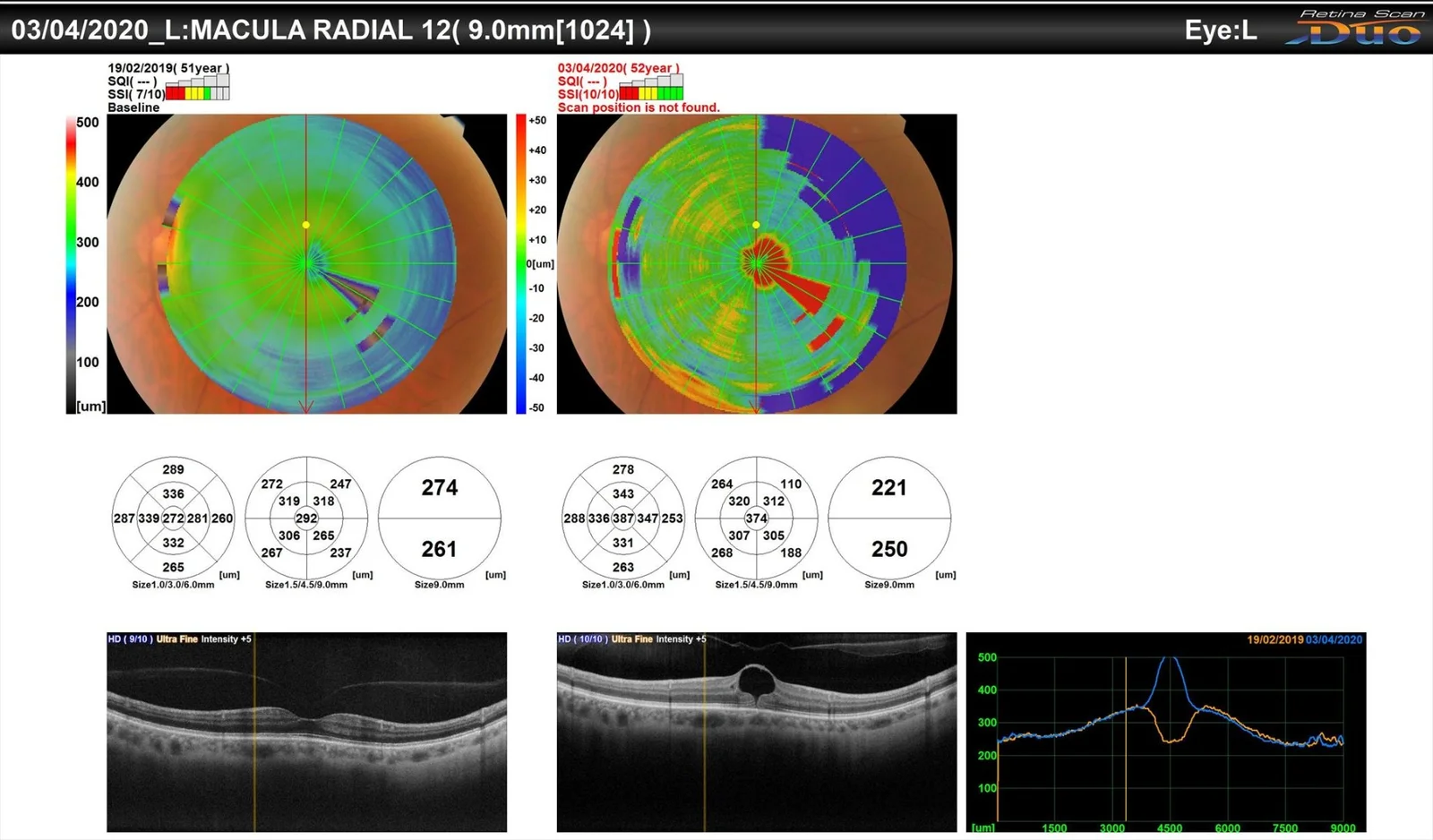 Spontaneous Closure Of Macular Hole Despite Presence Of Posterior Vitreous Detachment Pre Macular Hole Formation