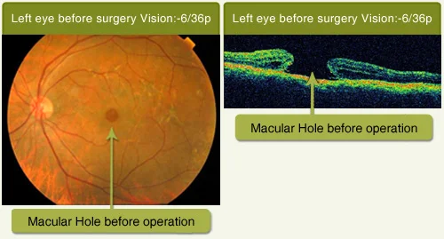 Macular Hole