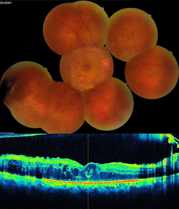 Case of Proliferative Diabetic Retinopathy