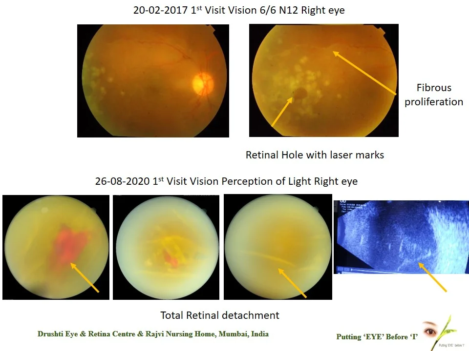 Follow up Must In Retina Patient's