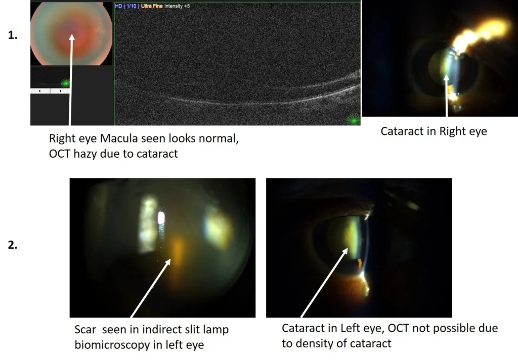Importance Of Complete Eye Examination Before Cataract Surgery