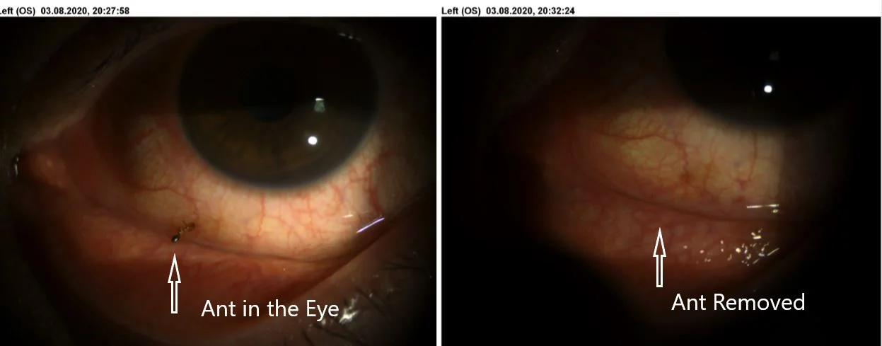 Importance Of Early Removal Of Foreign Body