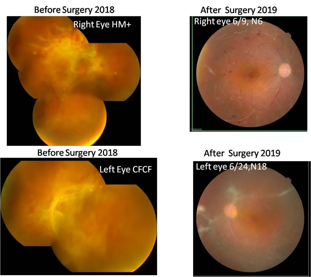 Proliferative Diabetic Retinopathy