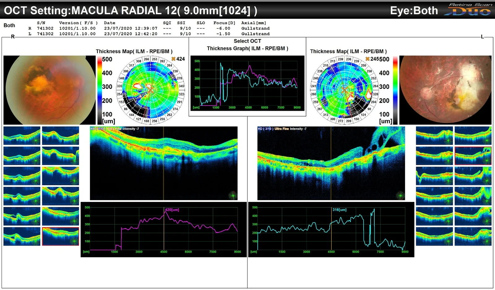 Reasonably Good Despite Wet Age Related Macular Degeneration (Disciform Scar)