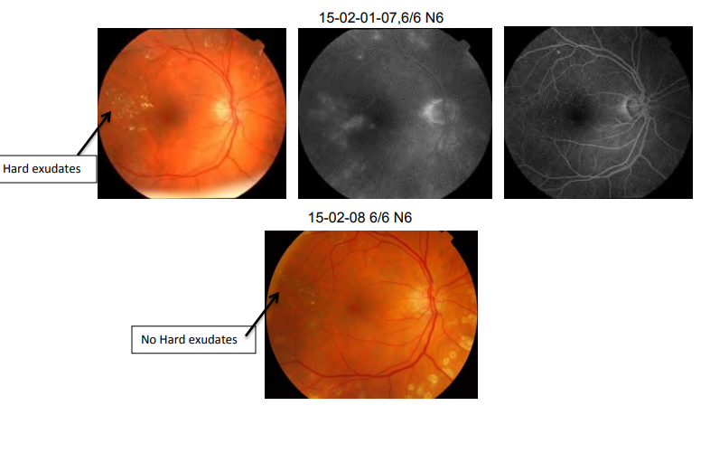Treatment Of Diabetic Macular Edema Without Intravitreal Injections