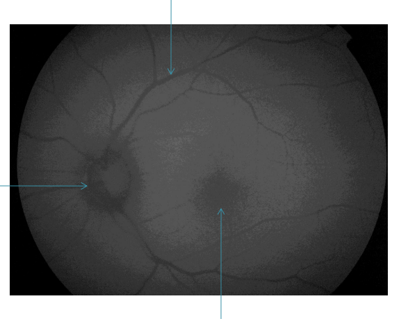 Uses of Fundus autofluorescence